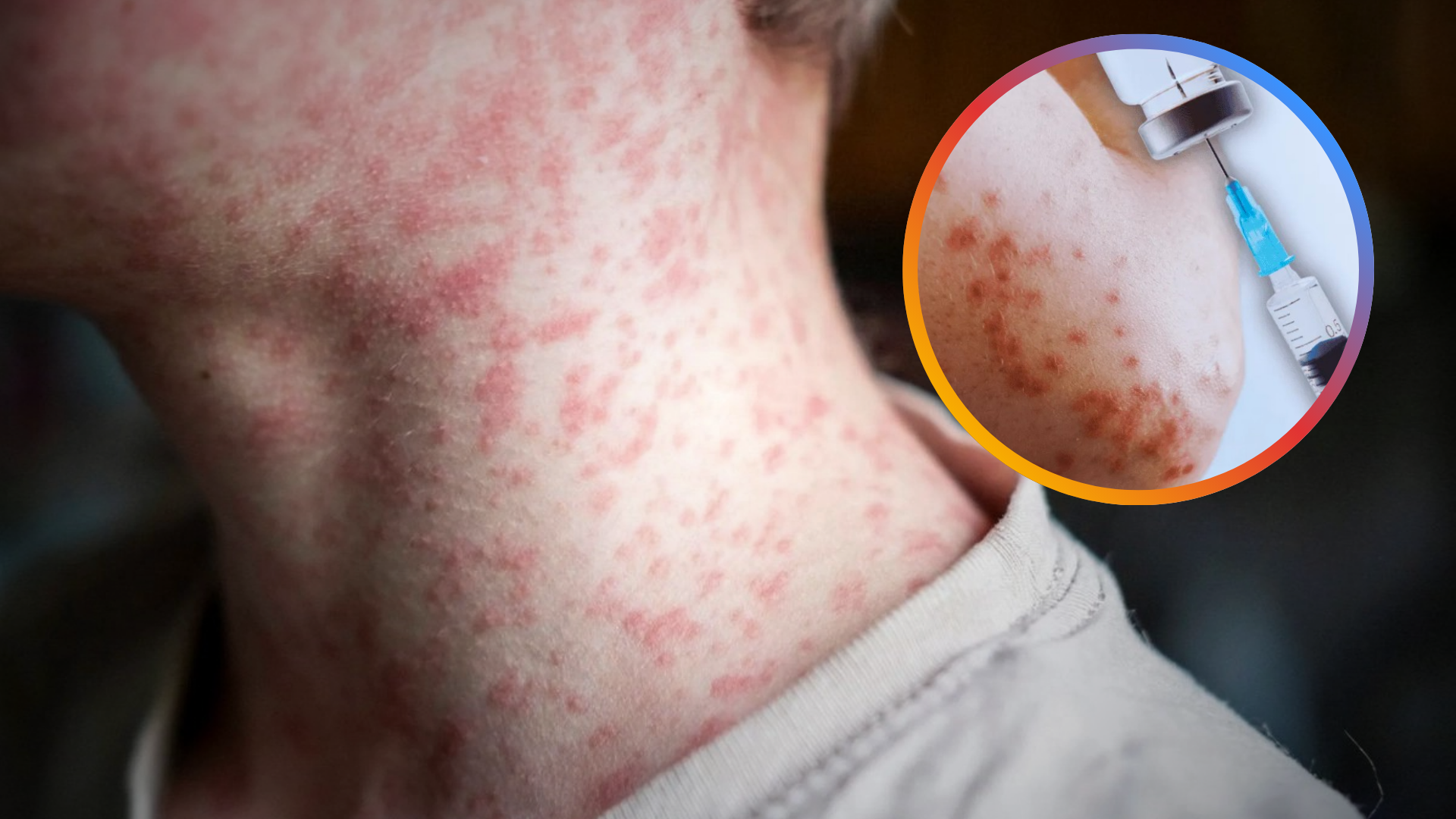 Salud vigila tres posibles casos de sarampión en Huatabampo, Etchojoa y Navojoa